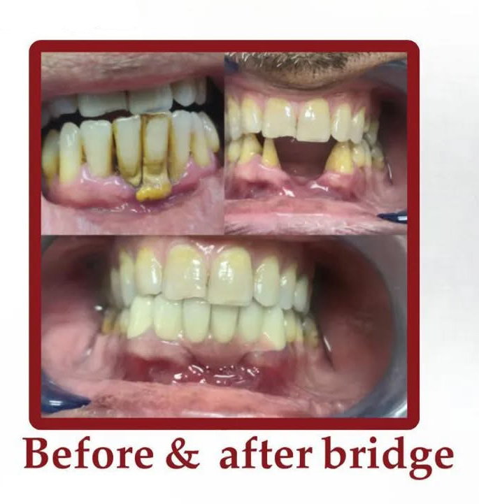 Dental Bridge Treatment